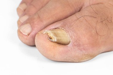 Yaşlı bir ayaktaki büyümüş ayak tırnağı ve beyaz bir sırtı var.