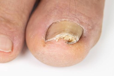 Yaşlı bir ayaktaki büyümüş ayak tırnağı ve beyaz bir sırtı var.