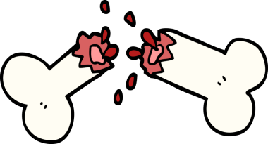 Bir insan tarafından çizilmiş kırık bir kemik.