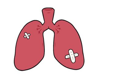 Basit bir çizgi film akciğerleri onardı.