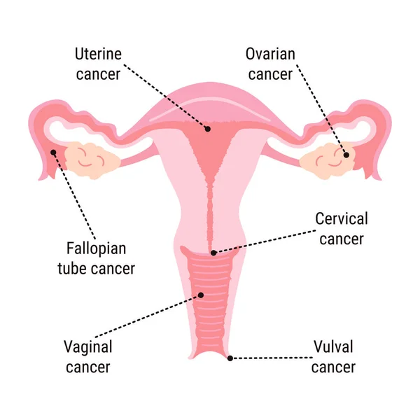 Gynaecologische Kanker Bewustwording Maand Infographic Belangrijkste Soorten Kanker Baarmoederhalskanker Eierstokkanker — Stockvector