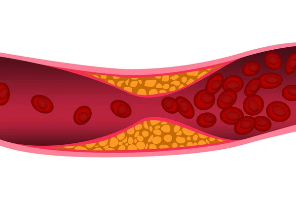 Colesterol Arteria Concepto Médico Representación — Foto de Stock