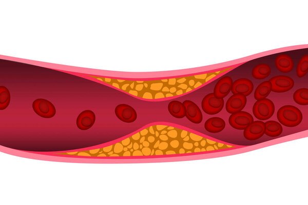 Cholesterol in artery. Medical concept, 3d rendering