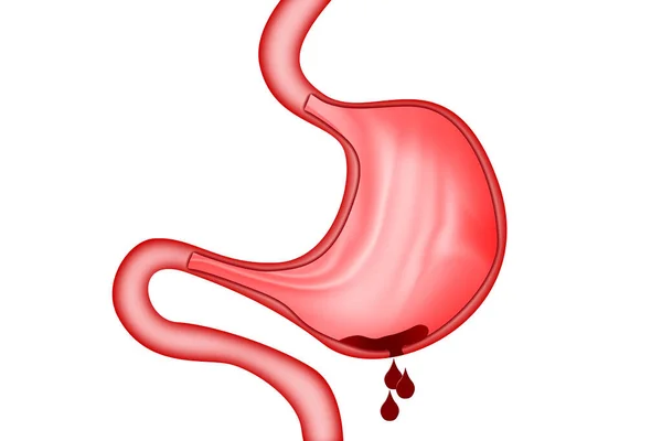 胃の分離 3Dレンダリングの穿孔 — ストック写真