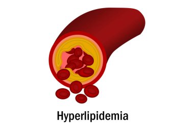 Kan damarı izole edilmiş hiperlipidemi.