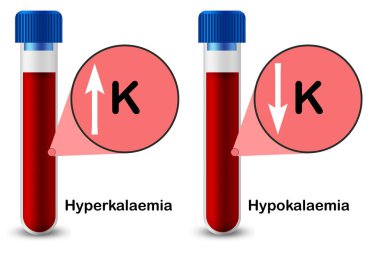 Hiperkalaemi ve hipokalemi. Test tüpünde test numunesi var. 3 boyutlu.