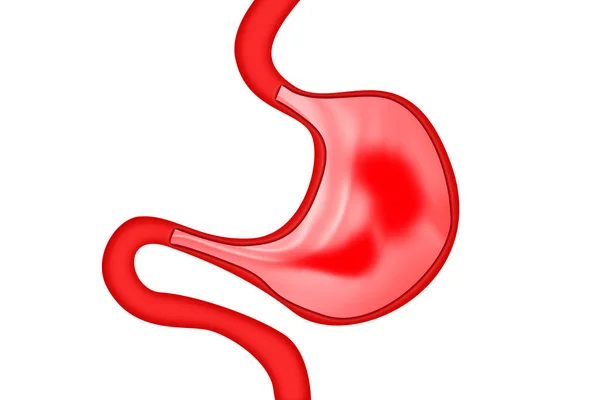 胃十二指肠炎 胃和十二指肠粘膜发炎 3D呈现 — 图库照片