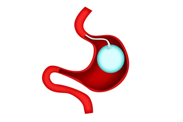 胃バルーン体重減少血管内手術 3Dレンダリング — ストック写真