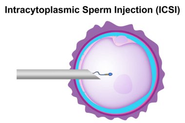 Intracytoplasmic sperm enjeksiyonu (ICSI) işlem diyagramı, 3d oluşturma