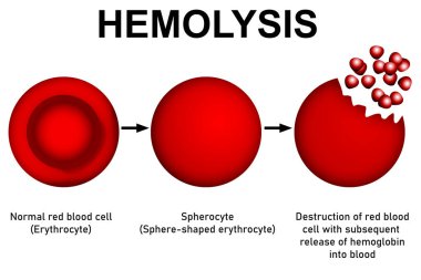 Scientific diagram and process of hemolysis , 3d rendering clipart