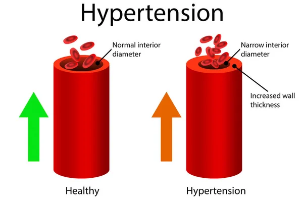 Healthy Hypertensive Blood Vessel Rendering — Stock Photo, Image