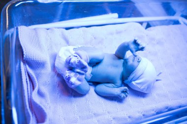 Yeni doğmuş bebek. Bebek, doğum hastanesinde mavi bir lambanın altında yatıyor. Yeni doğan sarılığın tedavisi
