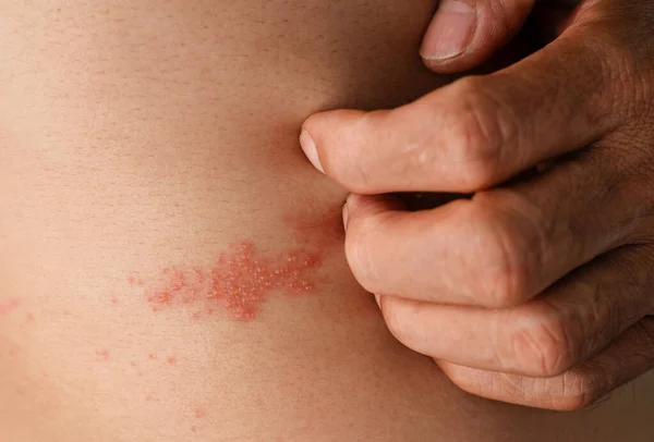 Man Met Gordelroos Huid Geïnfecteerd Met Herpes Zoster Virus Gezondheidszorg — Stockfoto