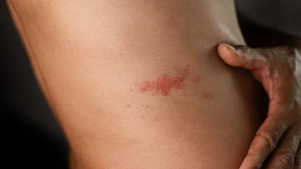 Man Met Gordelroos Huid Geïnfecteerd Met Herpes Zoster Virus Gezondheidszorg — Stockfoto