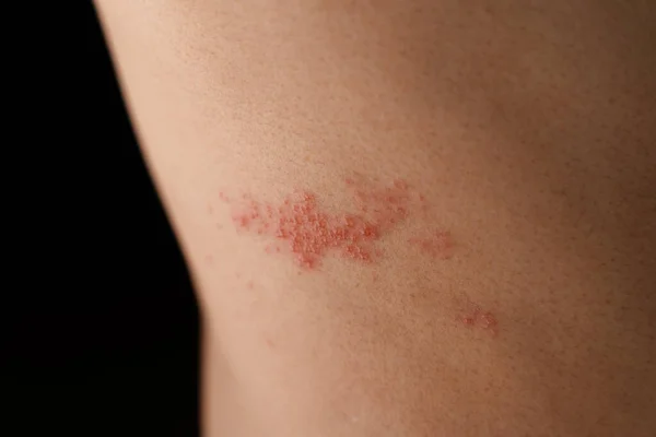 Man Met Gordelroos Huid Geïnfecteerd Met Herpes Zoster Virus Gezondheidszorg Stockfoto