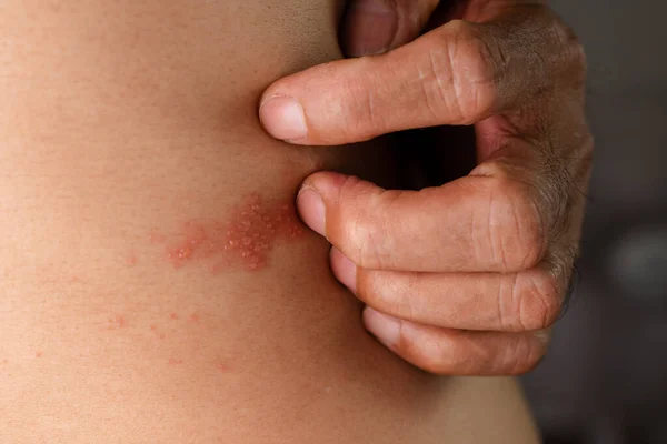 Homem Com Doença Das Telhas Pele Infectada Com Herpes Zoster — Fotografia de Stock