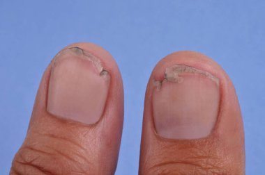 Hasarlı başparmak tırnakları mavi arkaplanda izole edilmiş.