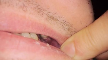 Man shows seam with black threads in mouth after implant placement surgery. Oral cavity of man and tooth implantation in clinic extreme closeup