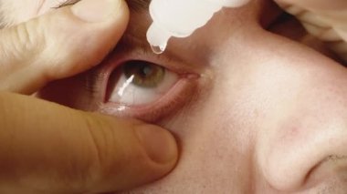 Person instills hydrating drops from vial into eyes for moisturizing after work on computer. Man opens eye wide with fingers extreme closeup