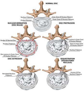 Types and stages of lumbar disc herniation, herniated disc, nuclear herniation, disc bulge, protrusion, extrusion, sequestration, lumbar vertebra, intervertebral disk, vertebral bones, superior view clipart