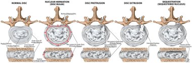 Types and stages of lumbar disc herniation, herniated disc, nuclear herniation, disc bulge, protrusion, extrusion, sequestration, lumbar vertebra, intervertebral disk, vertebral bones, superior view clipart