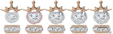Types and stages of lumbar disc herniation, herniated disc, nuclear herniation, disc bulge, protrusion, extrusion, sequestration, lumbar vertebra, intervertebral disk, vertebral bones, superior view clipart
