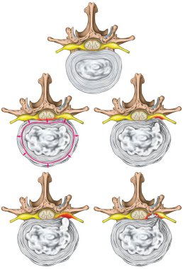 Nerves, types and stages of lumbar disc herniation, herniated disc, nuclear herniation, disc bulge, protrusion, extrusion, sequestration, lumbar vertebra, intervertebral disk, vertebral bones, superior view clipart