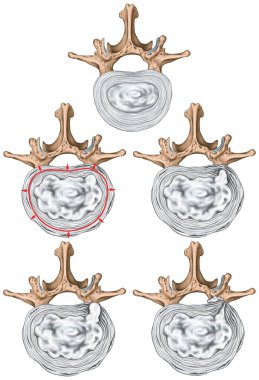 Bel fıtığı, bel fıtığı, fıtık, nükleer fıtık, disk çıkıntısı, çıkıntı, çıkıntı, tecrit, omurga, omurgalar arası disk, omurga kemikleri, üst düzey görüş.