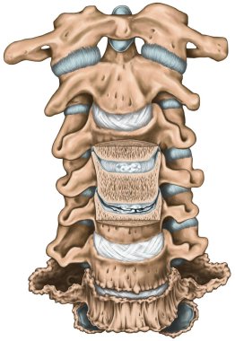 Degenerative changes in the cervical spine, uncinate process, uncovertebral arthrosis, anatomy of human bone system, uncovertebral joint, split intervertebral disc, coronal section, anterior view clipart