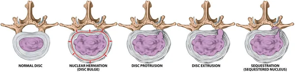腰椎ディスクヘルニア ヘルニアディスク 核ヘルニア ディスクバージ 押し出し シーケンス 腰椎椎 椎間ディスク 優れたビューの種類と段階 — ストック写真