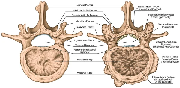 Segunda Vértebra Lumbar Columna Lumbar Hueso Vertebral Artrosis Cubierta Avanzada — Foto de Stock