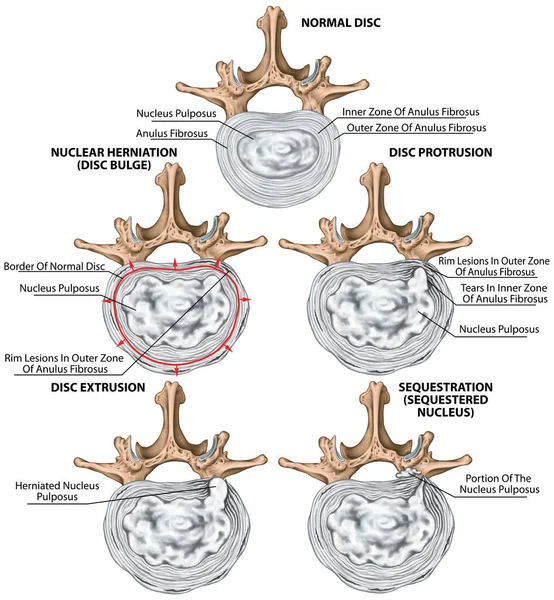Tipos Etapas Hernia Discal Lumbar Hernia Discal Hernia Nuclear Protuberancia —  Fotos de Stock
