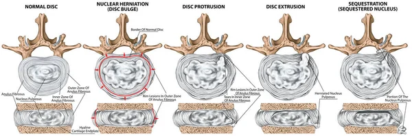 stock image Types and stages of lumbar disc herniation, herniated disc, nuclear herniation, disc bulge, protrusion, extrusion, sequestration, lumbar vertebra, intervertebral disk, vertebral bones, superior view