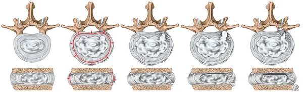 Types Stages Lumbar Disc Herniation Herniated Disc Nuclear Herniation Disc — Stock Photo, Image