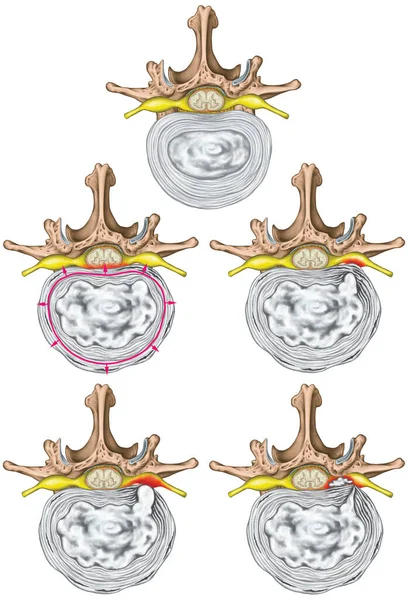 stock image Nerves, types and stages of lumbar disc herniation, herniated disc, nuclear herniation, disc bulge, protrusion, extrusion, sequestration, lumbar vertebra, intervertebral disk, vertebral bones, superior view