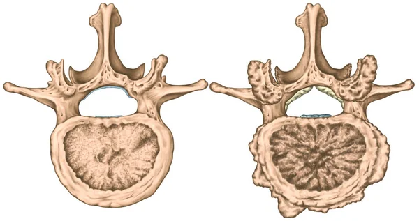 第二腰椎 先进的非椎体关节病 退变椎体 海绵体 关节骨关节炎 上视镜 图库照片