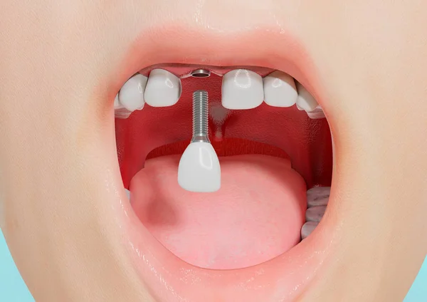 Lidský Implantát Zubního Řezáku Zubní Koruna Šroubem Zubní Ošetření Ilustrace — Stock fotografie