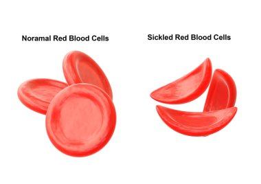 Sickle cell anemia is a hereditary disease characterized by the alteration of red blood cells, making them look like a sickle. 3D illustration clipart