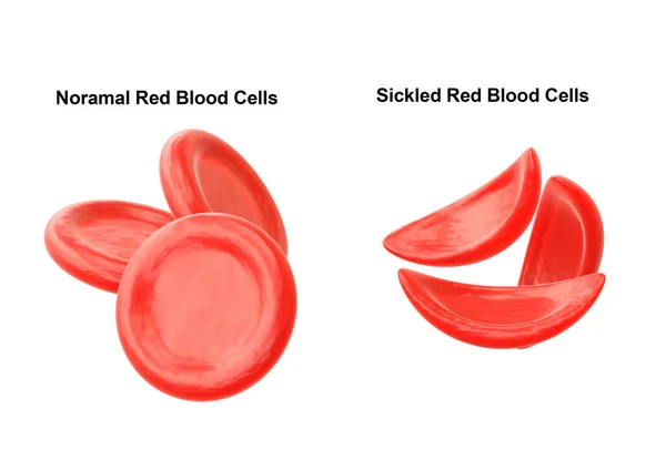 Sikkelcelanemie Een Erfelijke Ziekte Gekenmerkt Door Verandering Van Rode Bloedcellen Stockfoto