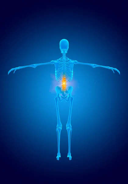blue hologram human skeleton, x-ray lumbar spine deviation and cartilage wear causing pain. 3D illustration