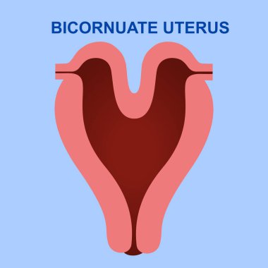 Bicornuate uterus, rahim iki parçaya ayrıldığında oluşan doğuştan gelen bir sakatlıktır. Tıbbi illüstrasyon