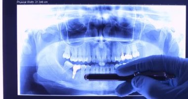 İmplantlarla diş röntgenini analiz eden bir doktor. Diş yapıları için radyografi araştırma konsepti. Dolly 4K çekti.