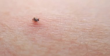 tick Macro photo on human skin. Ixodes ricinus. Bloated parasite bitten into pink irritated epidermis