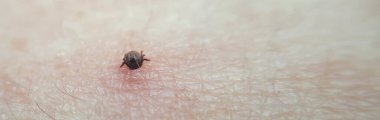 tick Macro photo on human skin. Ixodes ricinus. Bloated parasite bitten into pink irritated epidermis