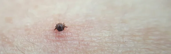 tick Macro photo on human skin. Ixodes ricinus. Bloated parasite bitten into pink irritated epidermis