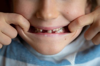 Closeup view of a toddler boy showing his missing milk teeth, holding the corners of his lips with his fingers.