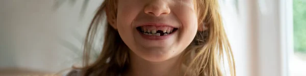Widok Bliska Uroczej Dziewczynki Uśmiechniętej Dwoma Brakującymi Zębami Szeroki Widok — Zdjęcie stockowe