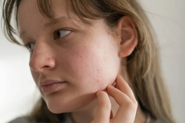 问题皮肤脸 一个面目全非的少女青少年畸形皮肤 关心问题的皮肤 痤疮治疗 — 图库照片