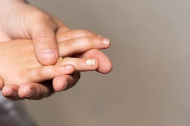 Tırnağı kırık bir çocuk eli. Acı veren çivi yaralı makro görüntüyü kaybetti