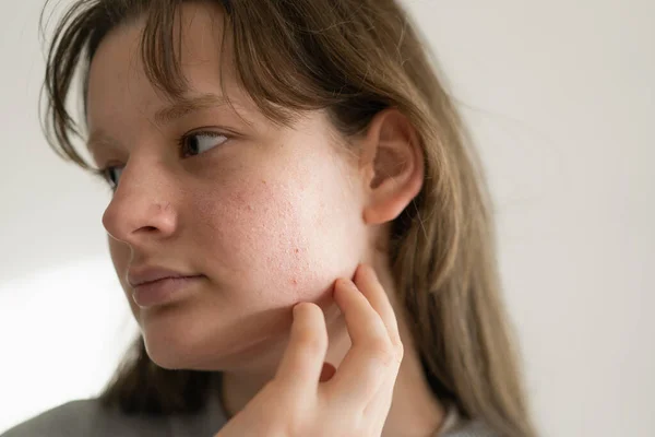Problemhud Ansikte Tonårstjej Med Ett Bekymrat Ansikte Problematisk Tonårshud Skötsel — Stockfoto